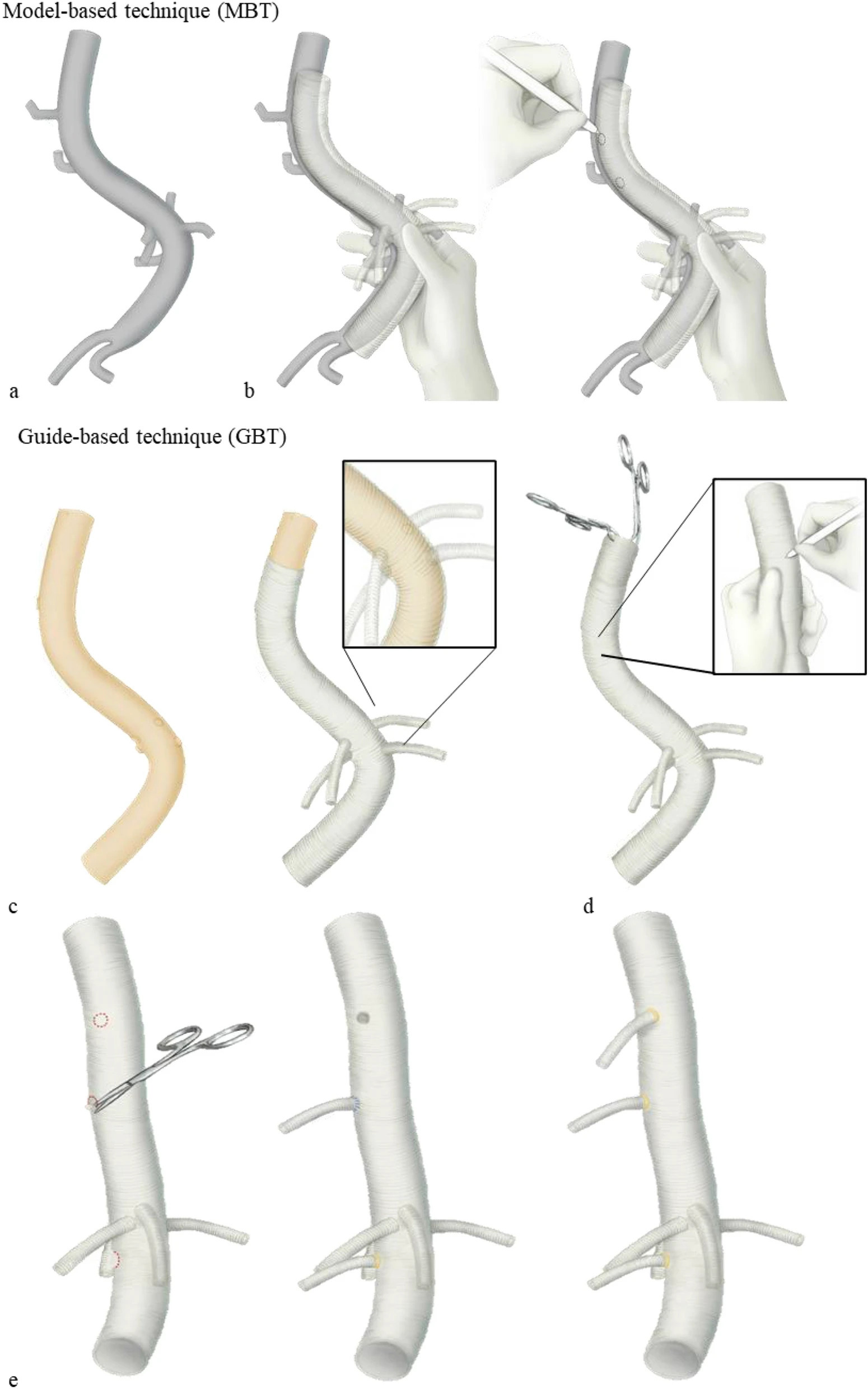 3D 프린터로 만든 수술 가이드, 대동맥류 수술에 큰 도움 < 의료기기·IT < 제약 의료기기 < 기사본문 - 헬스중앙