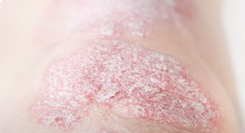 하얀 각질 쌓이고 가려움증 동반…건선 관리의 핵심 바로 알기