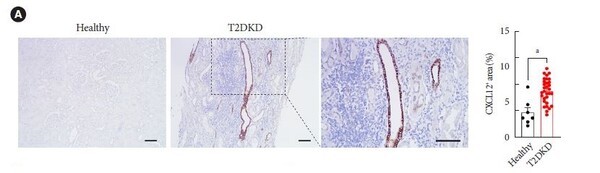 [그림] 당뇨병콩팥병(T2DKD)과 건강한 신장 조직 비교: 당뇨병콩팥병 조직에서는 CXCL12 발현이 증가하며, 특히 T 면역세포가 많이 침투된 부위에서 강하게 나타났다. 오른쪽 그래프는 당뇨병콩팥병 환자 그룹이 건강한 그룹에 비해 CXCL12 신장 발현이 증가함을 보여줌. 이는 CXCL12가 당뇨병콩팥병 환자의 신장 염증 진행에 중요한 역할을 한다는 것을 시사한다.