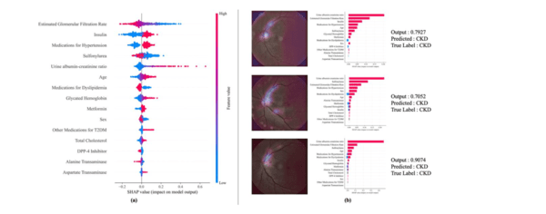 설명 가능 AI 분석을 통한 주요 위험 인자 기여도 시각화 결과