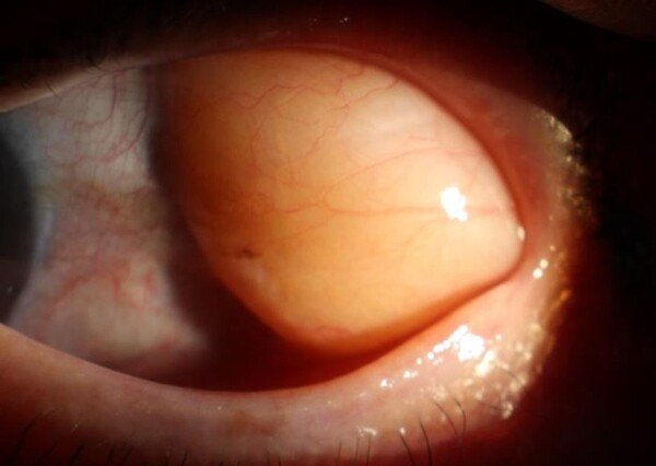 눈의 노화로 결막이 약해지면 지방이 앞으로 밀려나오는 '안와지방탈출'이 생길 수 있다. [사진 김안과병원]