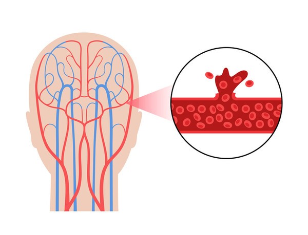 뇌졸중은 뇌혈관이 막히거나 터지면서 뇌세포가 손상되는 질환이다. [출처: Gettyimagesbank]