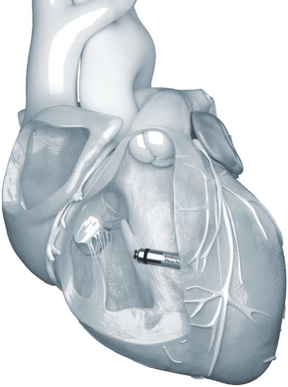 무전극선 심박동기 삽입 모습.