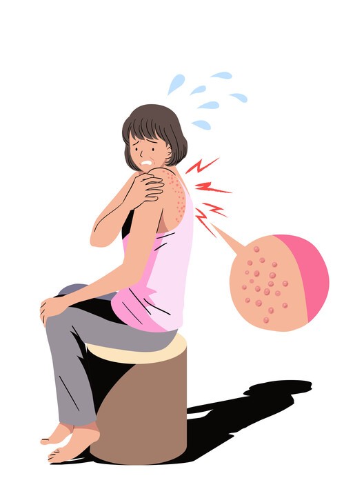 대상포진은 발진이나 물집이 생기고 72시간(3일) 이내에 항바이러스제를 복용하면 증상 호전 속도가 빨라진다. [출처: Gettyimagesbank]